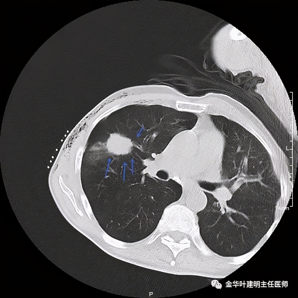 得了肺癌做肺部穿刺有影响吗,肺部穿刺可以确诊肺癌吗