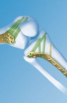 手术钢钉国产是什么材质的,进口的关节假体有两种吗