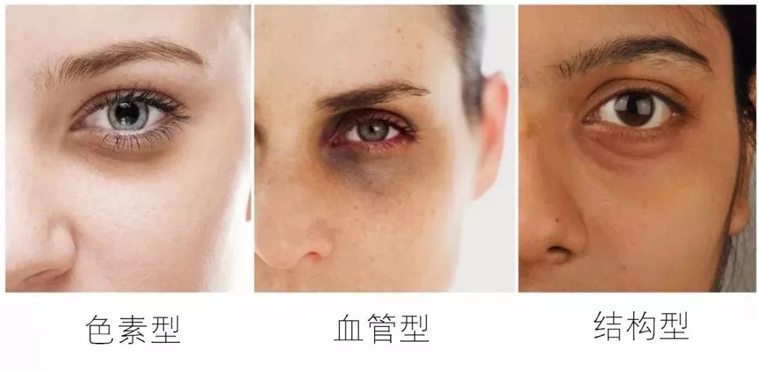 黑眼圈脂肪粒什么原因,眼部有细纹和黑眼圈的最简单方法