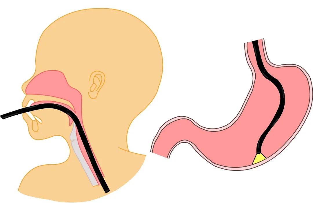胃镜检查全过程小视频,肠胃镜检查全过程视频