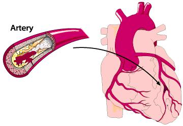 心脏病有功能分级，日常生活中有什么用，看看医生怎么说
