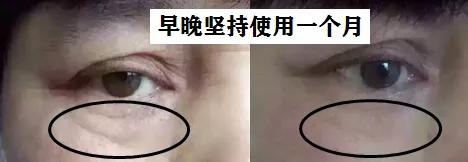 去眼纹去黑眼圈用什么方法,去眼袋黑公认最好用的土方法