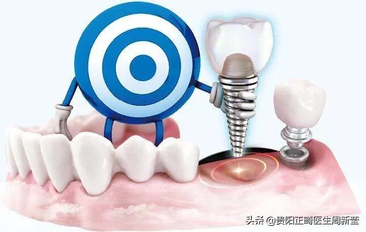 牙齿出现龋齿怎么解决视频,出现龋齿怎么办