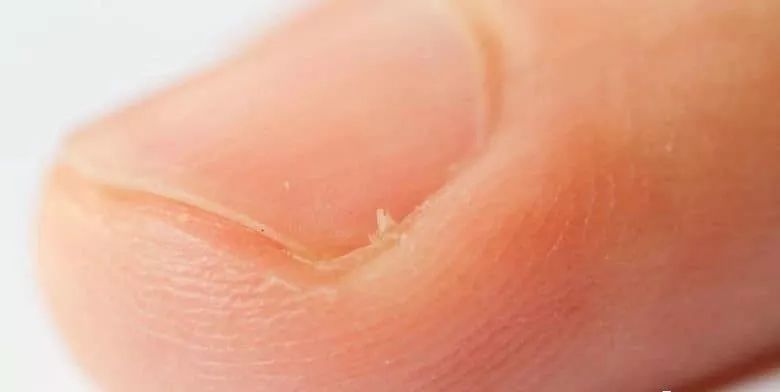 娃指甲上有白点是怎么回事,孩子指甲横纹有白点