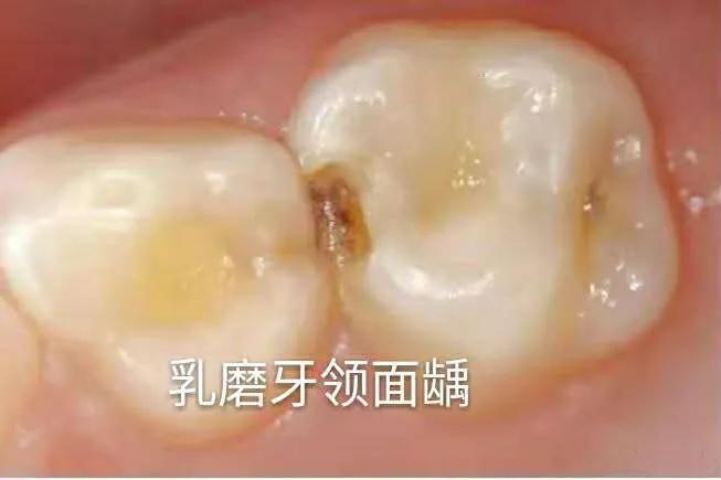 用牙线牙龈就出血正常吗,用牙线会流血