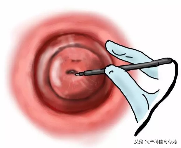 宫颈囊肿7*6mm纳氏囊肿需要治疗吗,宫颈囊肿巧克力囊肿