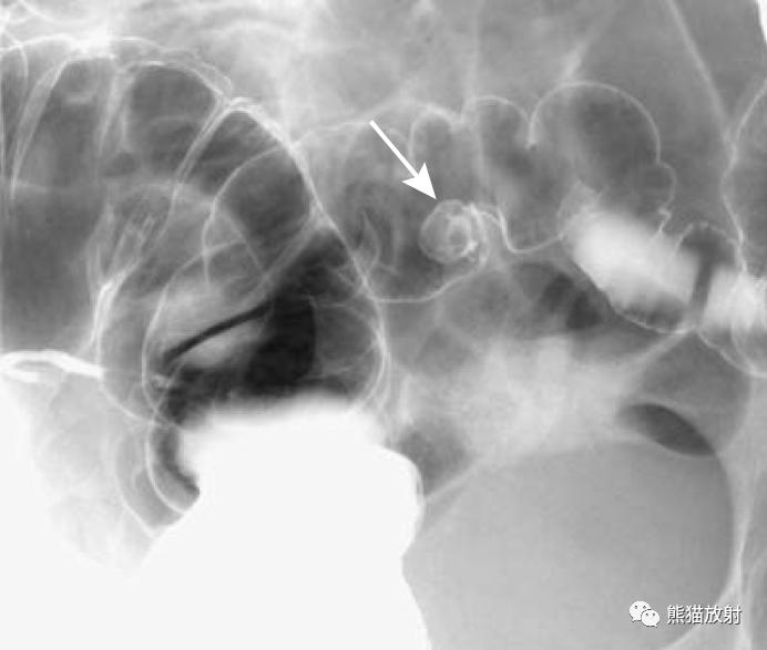 腹部影像图片大全,乙状直肠疼痛位置图片