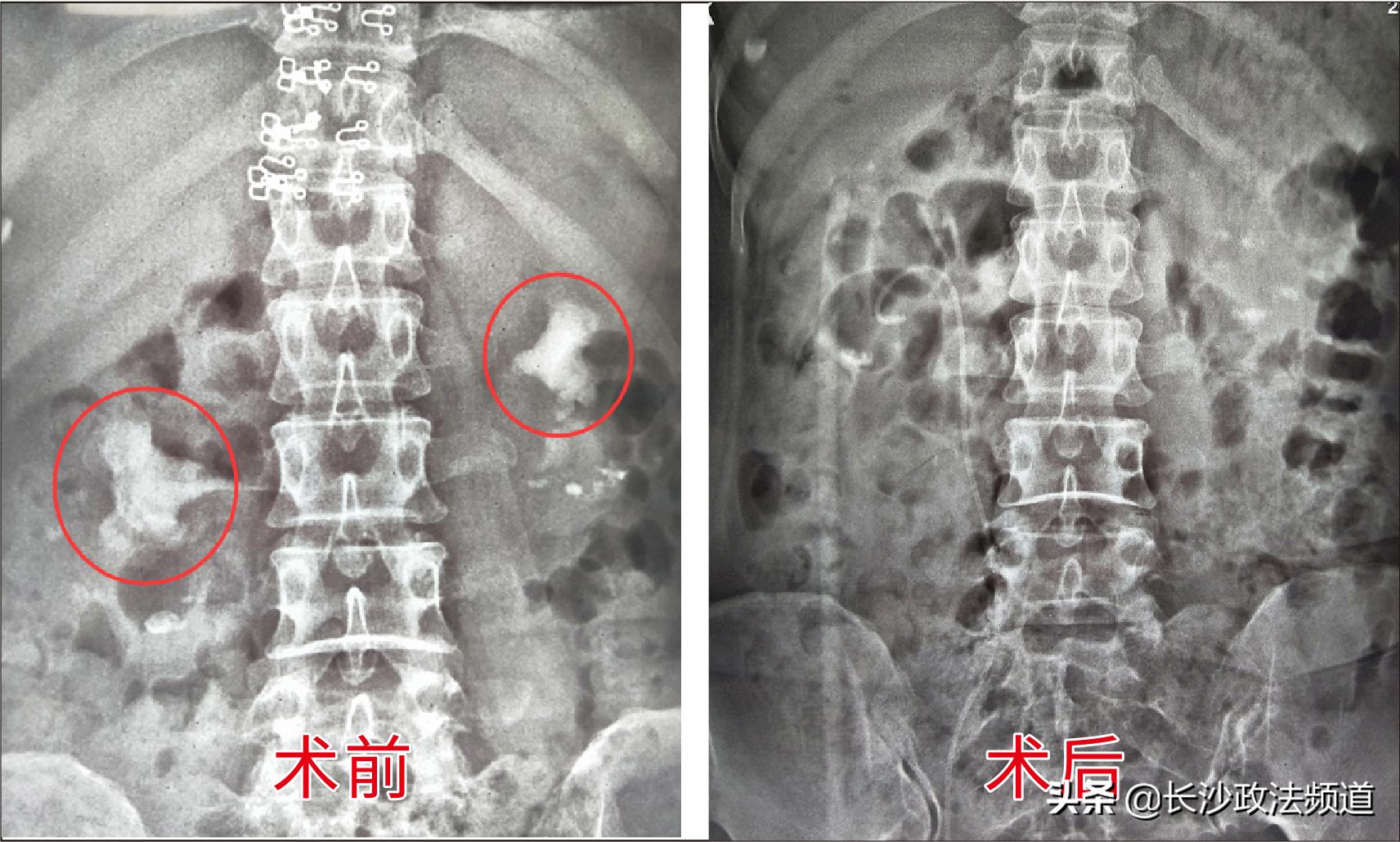 女子结石没及时就医,女子患肾结石