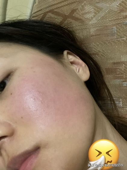 脸部泛红红血丝补水可以改善吗,脸部泛红怎么改善皮肤薄