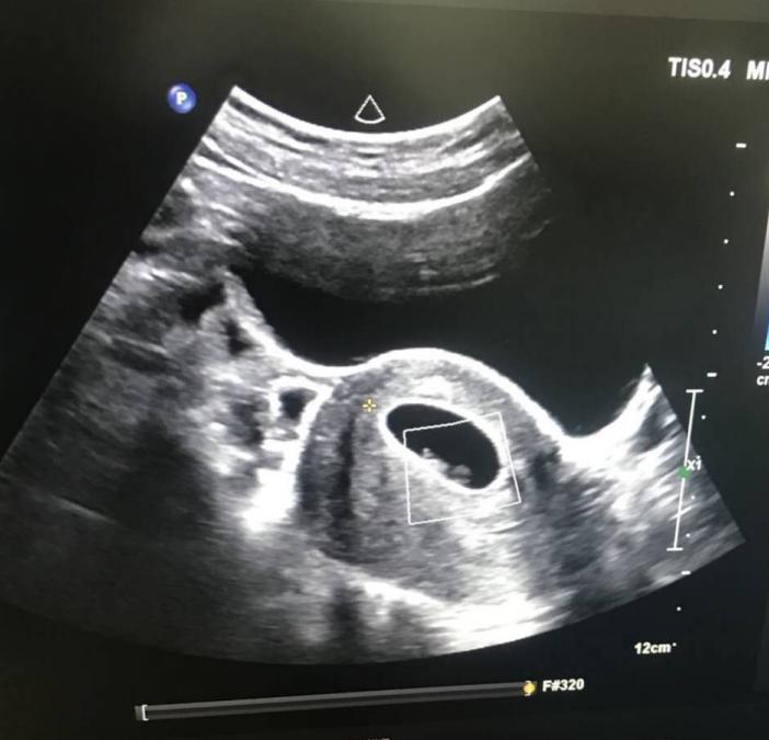 宫腔粘连导致例假变少可以备孕吗,为什么宫腔粘连术后月经量变少了