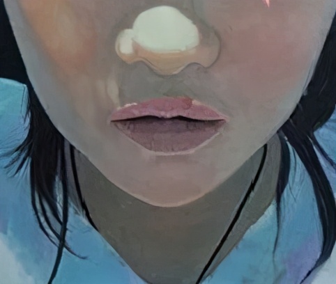 蒜头鼻怎么自己矫正,蒜头鼻塌鼻梁朝天鼻怎么改善