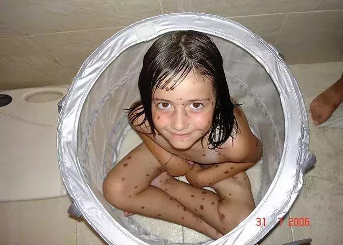 全身黑斑被骂“斑点狗”，身高160的她却成为最美超模…