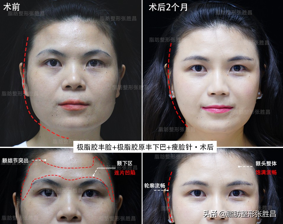 脂肪填充第二天的感受,下巴脂肪填充真实感受