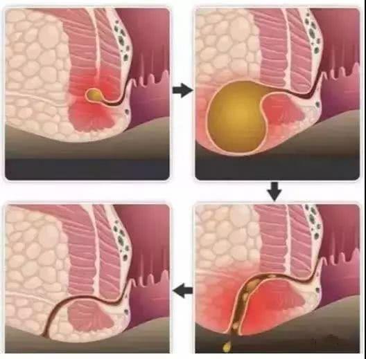 屁股火疖子会引起肛瘘吗,屁股起火疖子出脓要不要挤干净