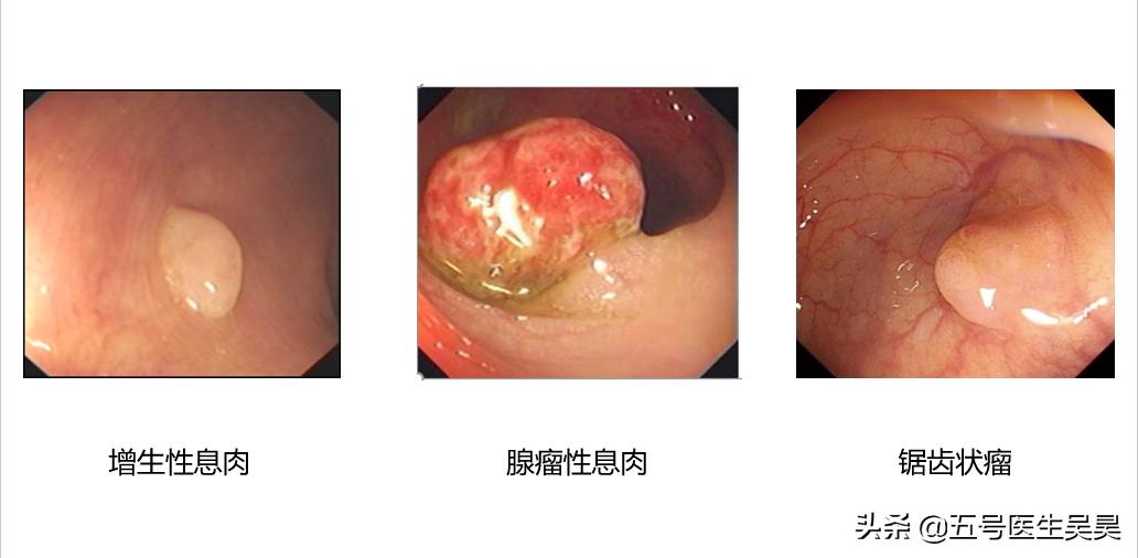 肠道长了“息肉”不要怕，搞清楚这6个问题，医生都给你点赞