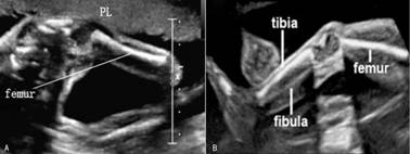 胎儿脊柱超声正常表现是怎样的,胎儿脊柱的超声诊断