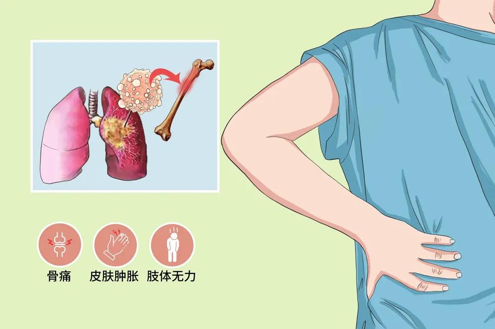 腰痛与肺癌有关吗,腰痛的厉害是得了肾癌吗
