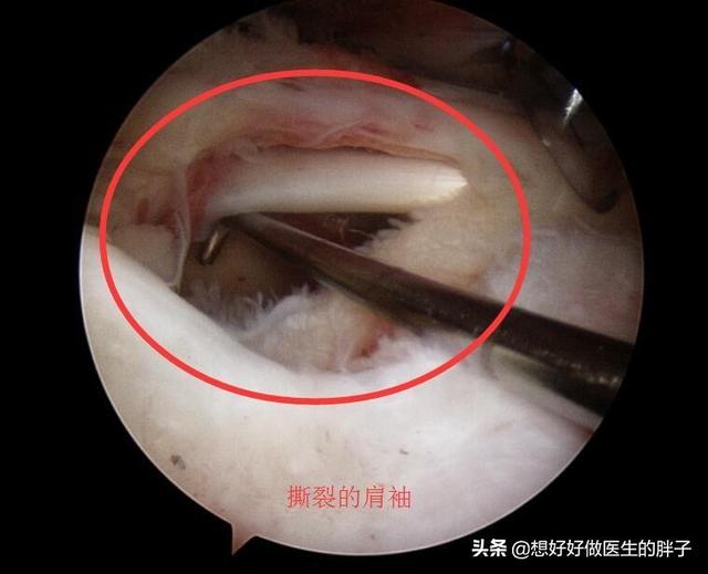 左侧肩膀疼痛预示十种病,哪些病可引起肩膀痛后背痛颈椎痛