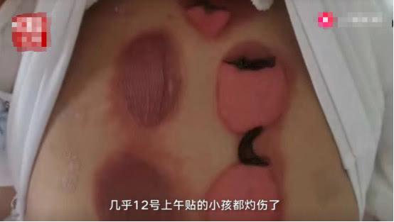 贵阳小孩子贴敷被灼伤,小孩贴三伏贴红肿起泡正常吗