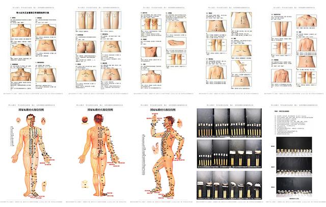 化脓灸是不是把肉灸出疤,古人的化脓灸不会损害身体吗