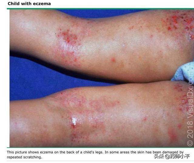 宝宝湿疹妈妈应注意哪些,宝宝湿疹反复妈妈要一直忌口吗