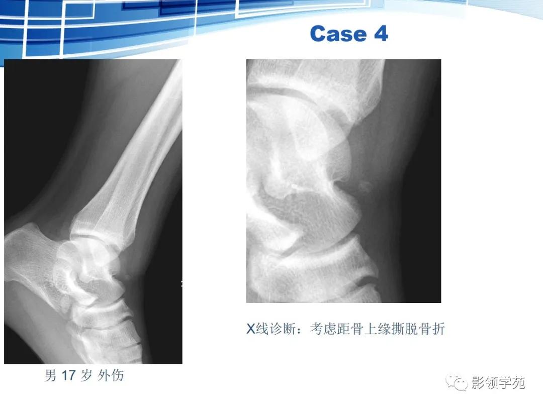 桡骨远端骨折引起尺骨变异,撕脱骨折一个月无明显骨痂形成