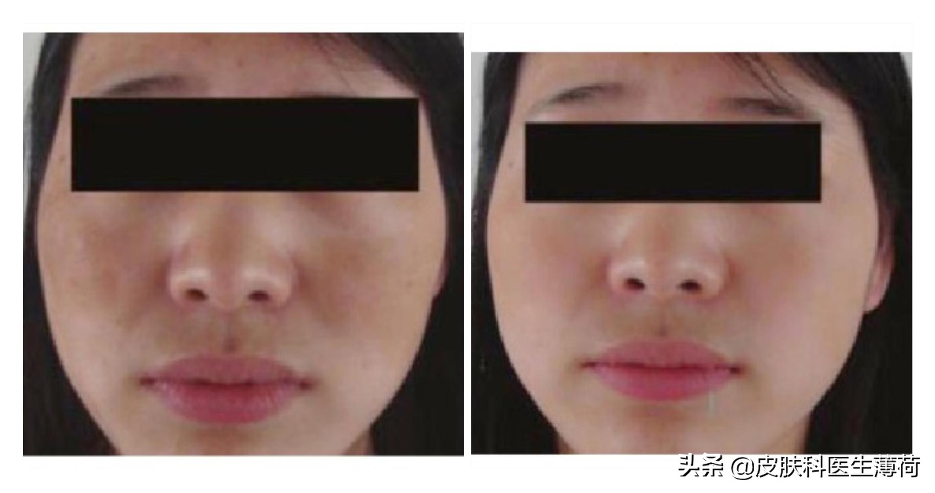 祛斑祛红色痘印激光,点阵激光祛斑仪器