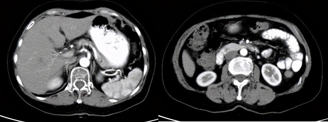 sbrt肿瘤放疗副作用有哪些,复发宫颈癌常用化疗方案