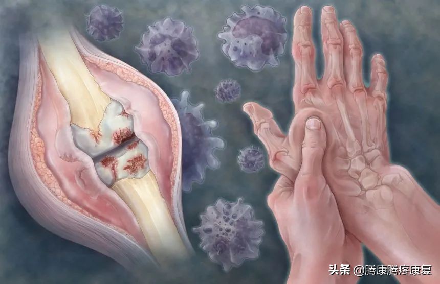 类风湿关节炎病因与发病机制,类风湿关节炎的病因与发病机制