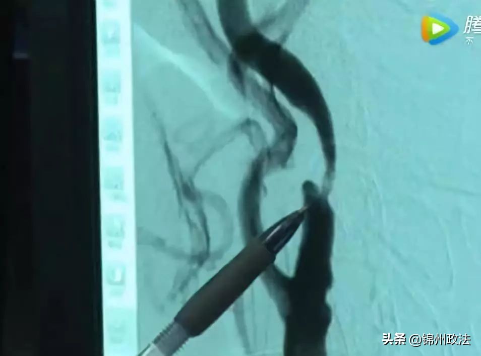 男子体内抽出2升油脂,男子体内取出一升油脂