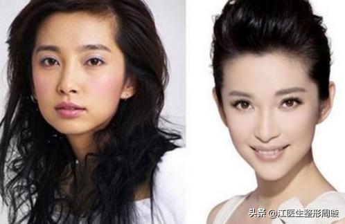 瘦脸针不要随便打,瘦脸针连续打几年真实感受