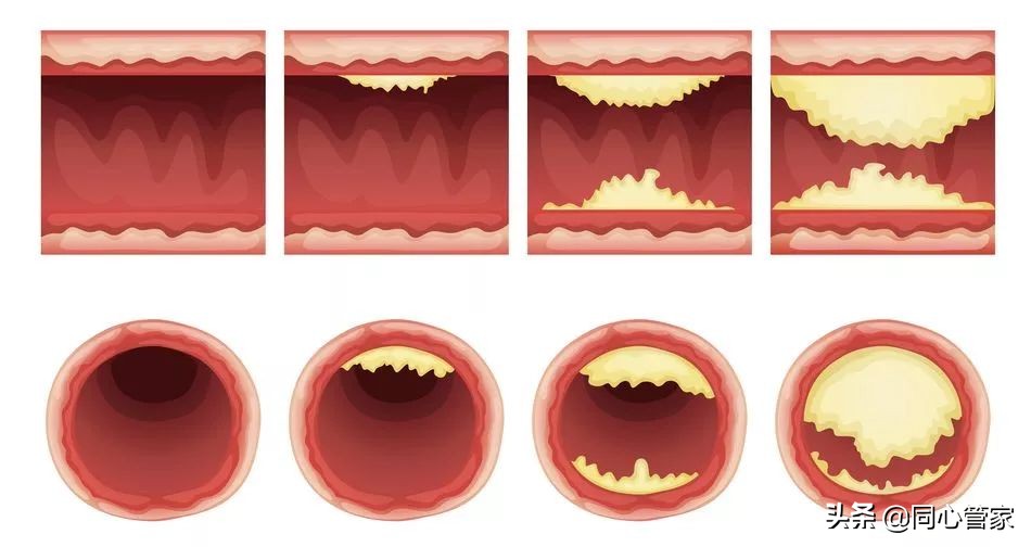 血管狭窄如何扼住生命的咽喉？让你全身器官都遭殃？