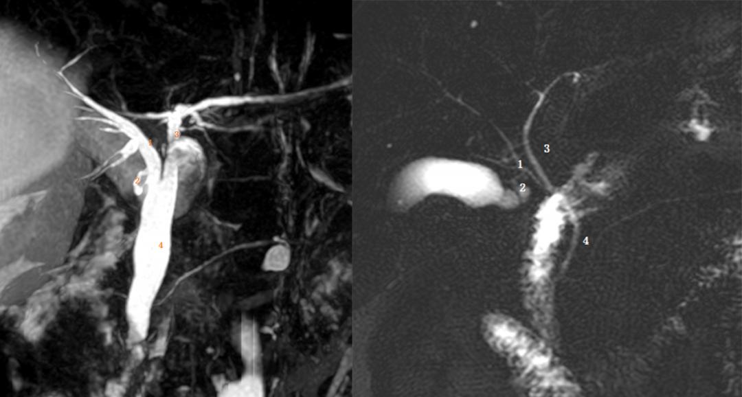 胆道系统解剖生理讲课视频,超声胆道系统的解剖生理