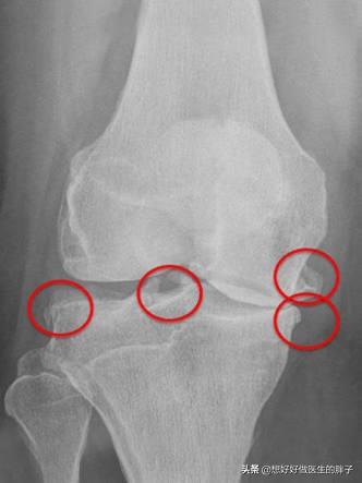 膝盖酸困无力是什么原因引起的,膝盖酸沉身体乏力是怎么回事啊