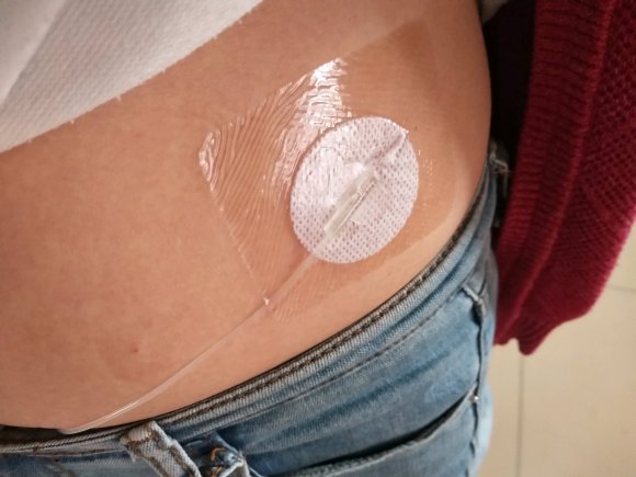 糖尿病患者佩戴胰岛素泵,1型糖尿病人戴胰岛素泵的好处