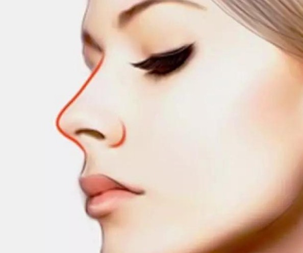 鼻整形应该选择什么样的医生,鼻整形有哪些术式