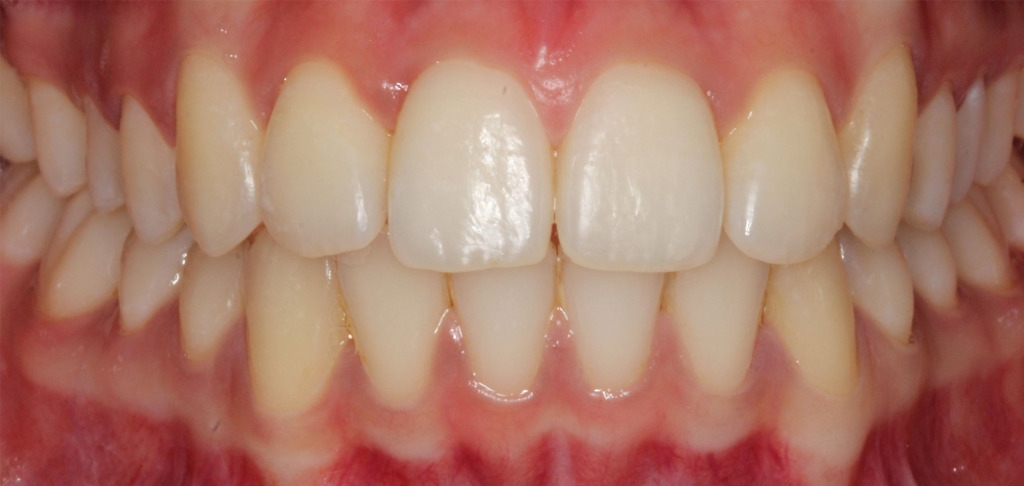 爱美者的100个困惑,牙齿缺失不想种植怎么办