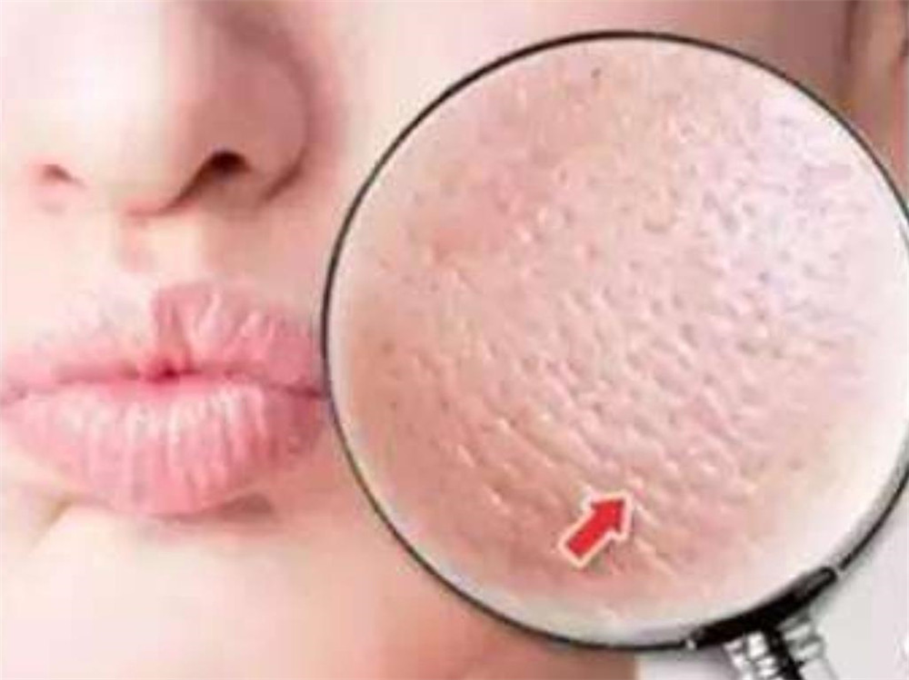 鼻子毛孔粗大如何改善学生党,鼻子毛孔粗大最好的解决方法