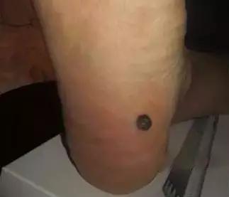 一病一绝招,治疗一病一穴奇效法