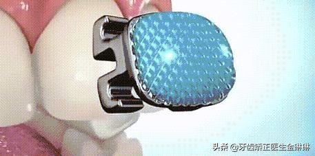 矫正牙齿不拔牙出现龅牙怎么办,40岁矫正牙齿拔牙不拔牙有区别吗