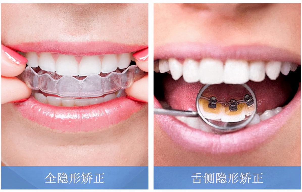 上海舌侧正畸医生,上海舌侧矫正哪家好