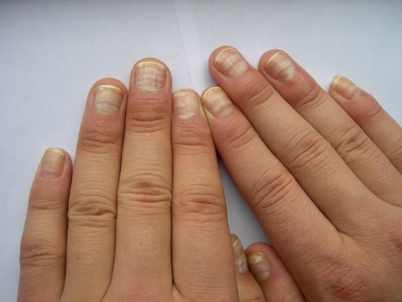 小小的指甲隐藏大大的健康秘密,小小指甲大调查