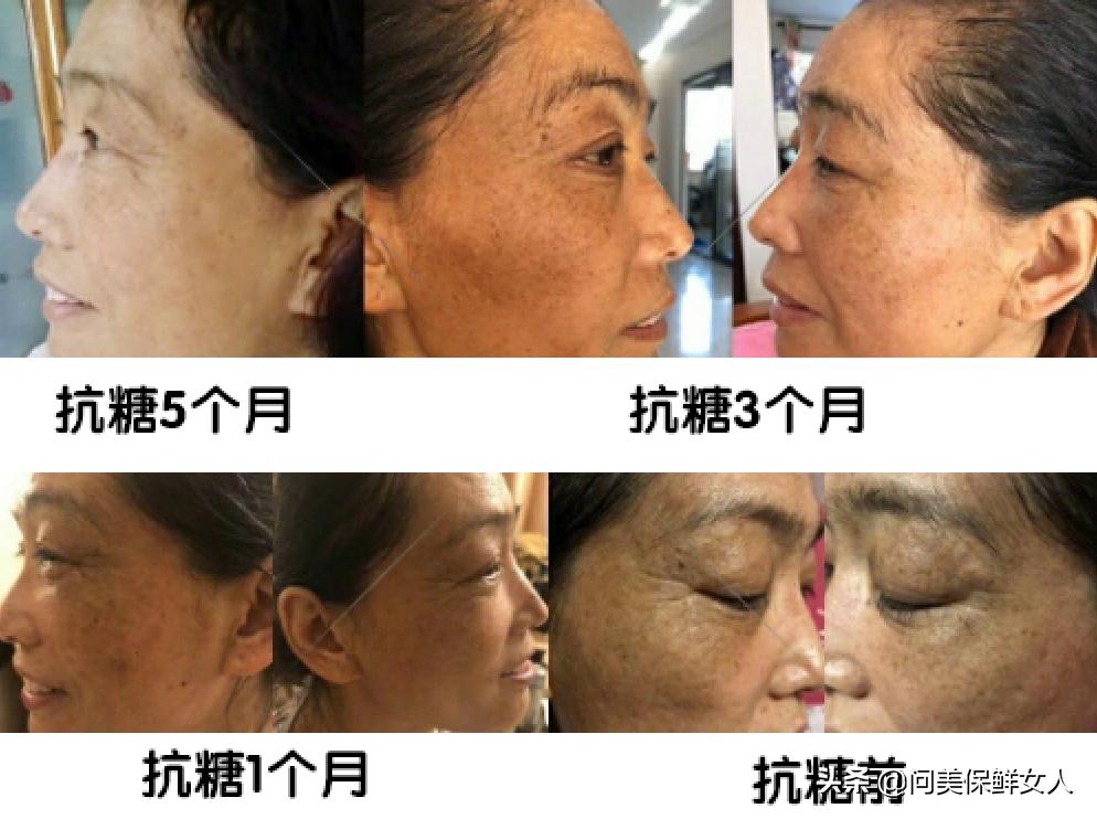 30岁前容易长斑的原因,容易长斑是不是黑色素太多