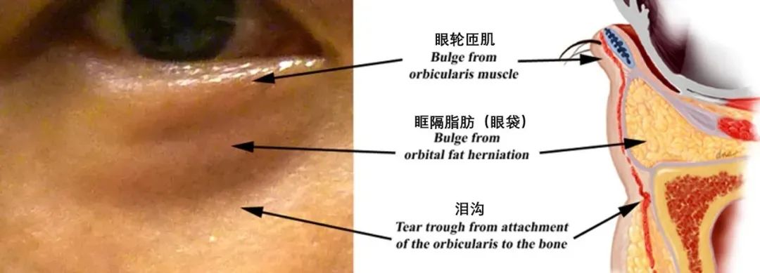 专家说痔疮膏治黑眼圈,网络流行的痔疮膏去黑眼圈
