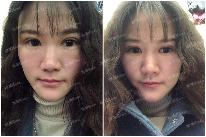 广州双眼皮凹陷修复视频,小切口双眼皮肉条修复