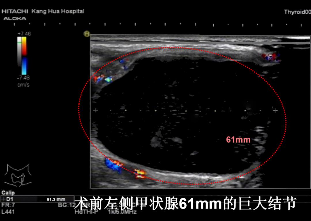甲状腺结节微创消融手术,甲状腺结节微创消融医保