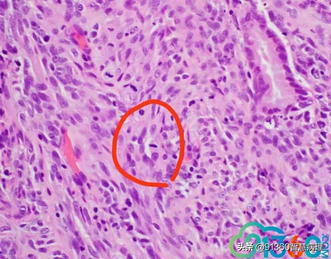 宫颈腺癌silvaa型严重吗,宫颈腺癌silvab型复发率高吗