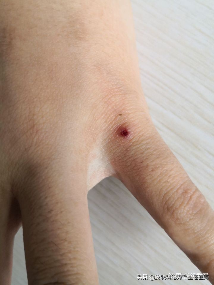 疥疮具有诊断意义,疥疮在临床上如何确诊