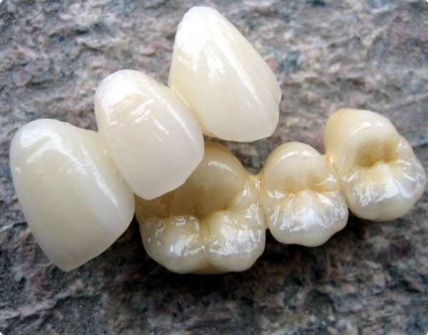 假牙价格一览表图片,假牙种类及价格表图片