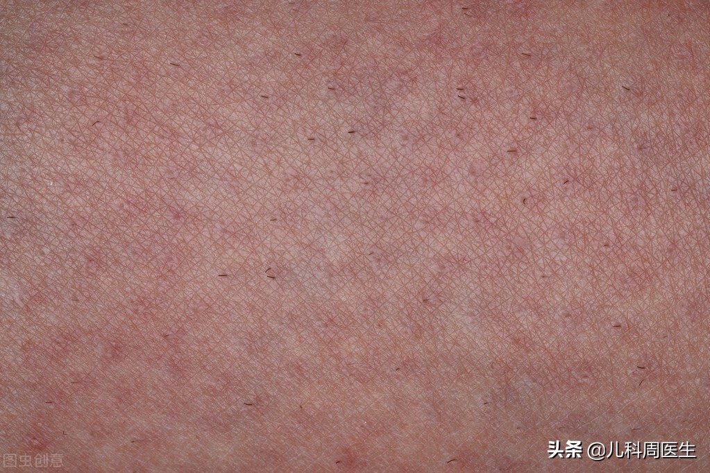 春天起水痘,如何辨别水痘和麻疹